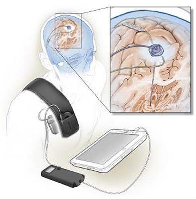 Totally Implantable Bidirectional Neural Prostheses: A Flexible Platform for Innovation in Neuromodulation